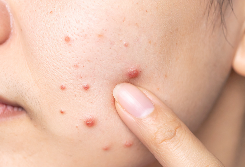 Pimples & Abscess Care