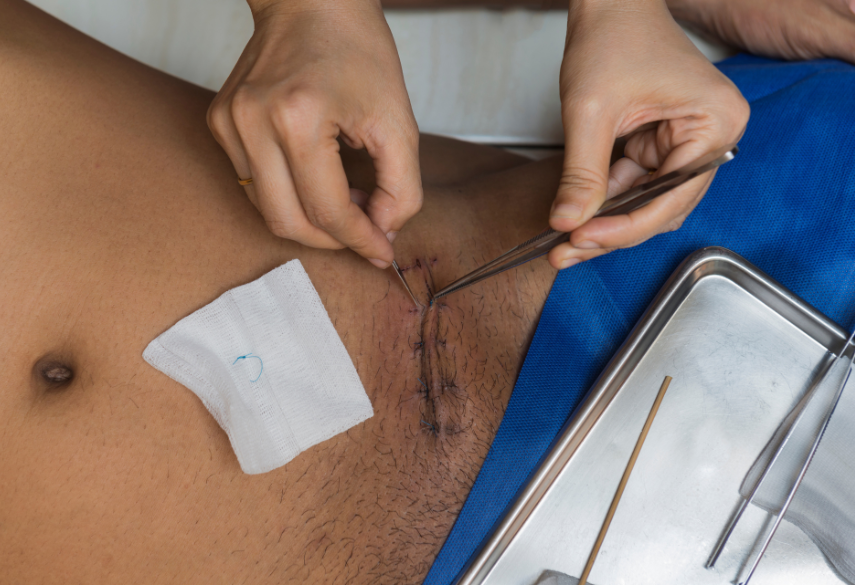Suture Removal