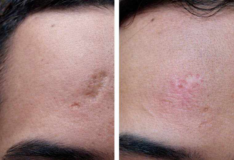 Microneedling