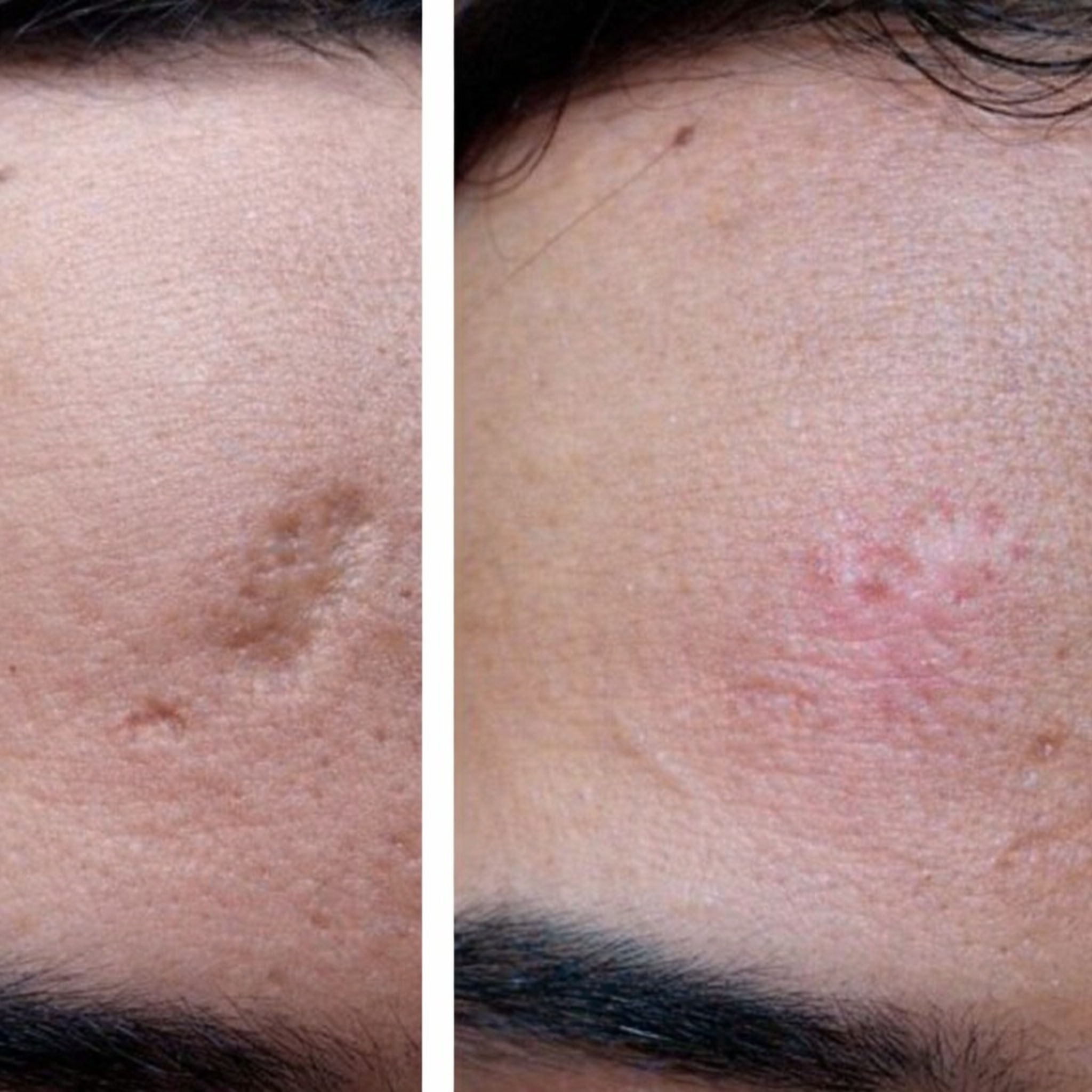Microneedling Treatment
